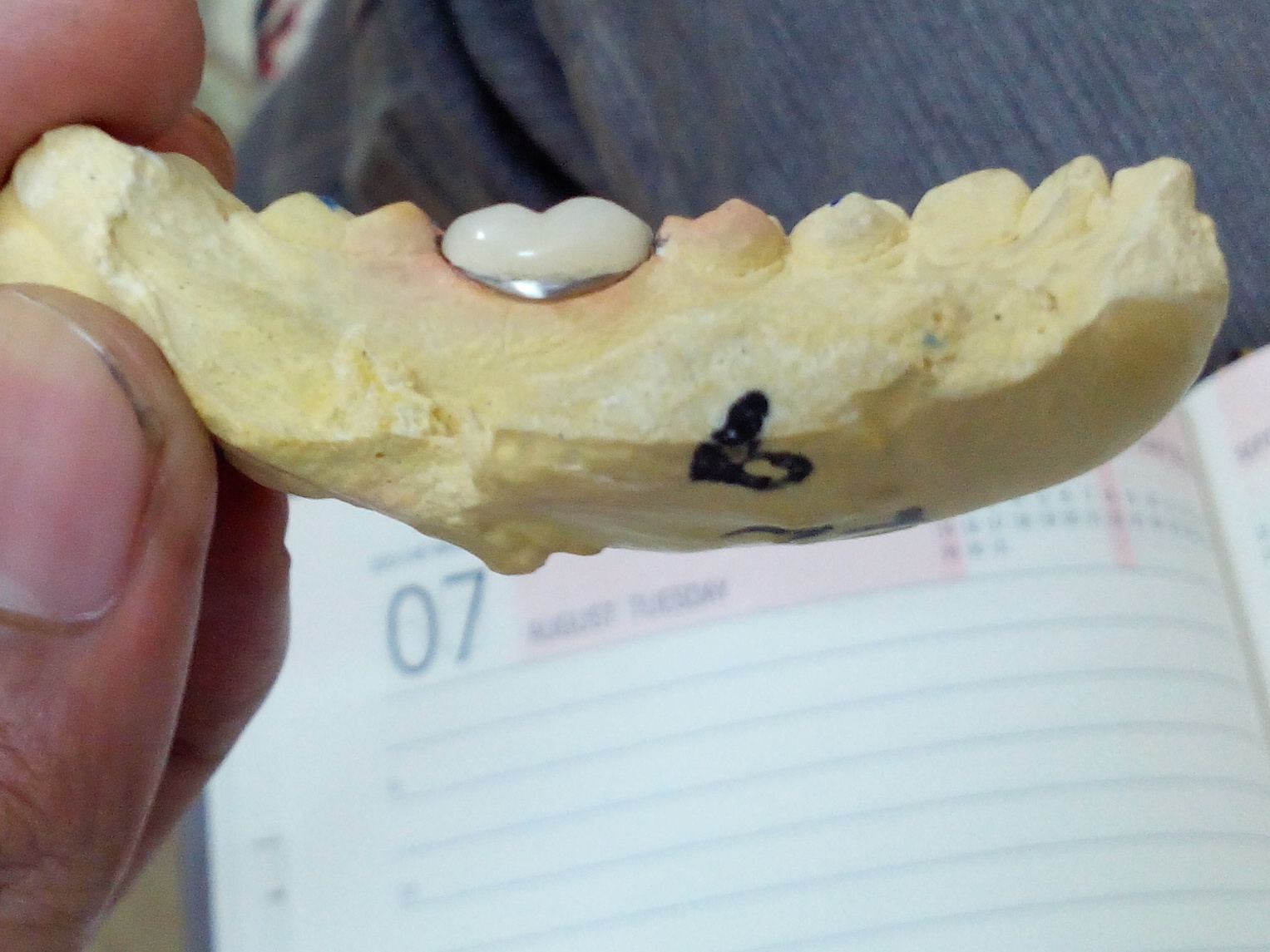 Corona de porcelana fundida sobre metal en modelo dental