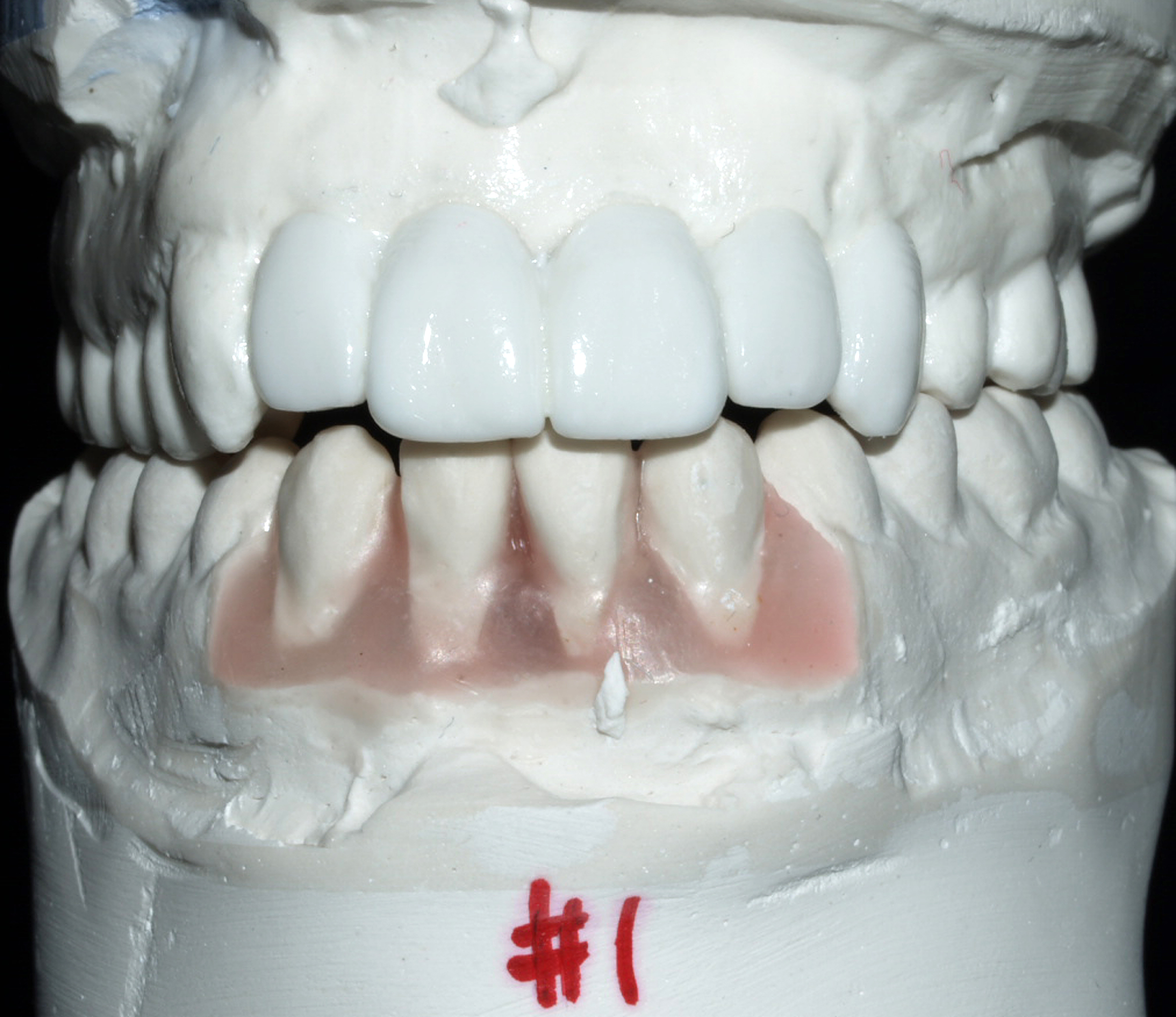 Prótesis fija dental sobre modelo de laboratorio