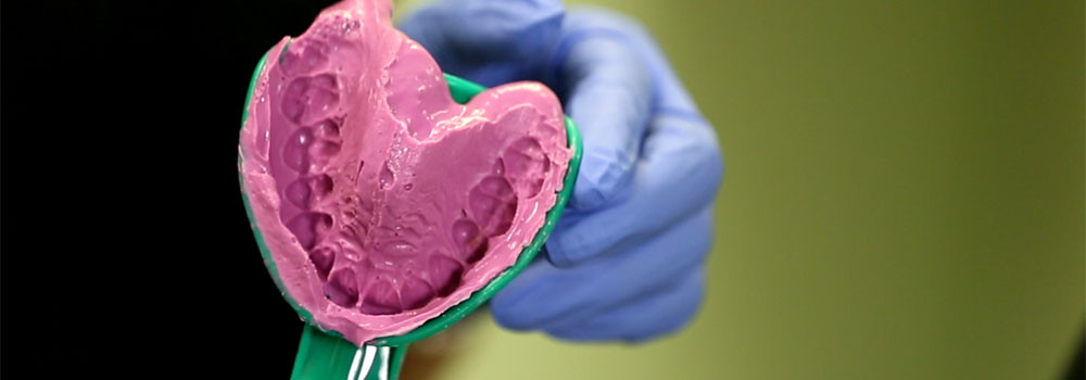 Impresión o molde dental, primer paso para elaborar una prótesis removible