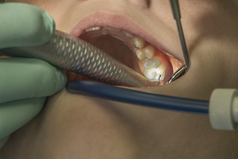 Tratamiento dental en curso, restauración de una pieza dental